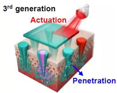 第三代：通过微针介导的皮肤层破坏和微针伴随的各种功能增强药物转运.jpg